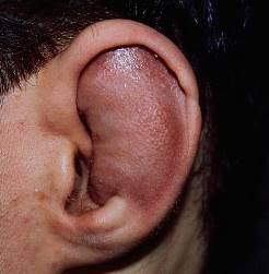 Реабилитация после отопластики сколько заживают уши, как проходит период