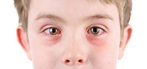 Дексаметазон детям инструкция по применению и дозировка глазных капель