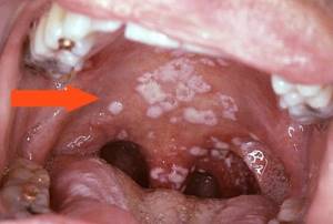 Сухость в носоглотке - причины и лечение пересыхания в горле