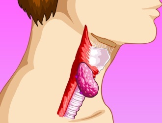 Симптомы и признаки рака горла - факторы риска и предраковые изменения
