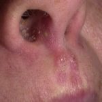 Фурункул в носу фото, как лечить чирей, осложнения