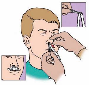 Тампонада носа при кровотечении: техника проведения, виды