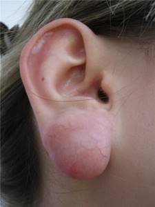 Жировик на мочке уха причины, лечение и профилактика