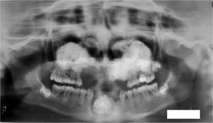 Рентген пазух носа при гайморите - описание патологии, проведение рентгена