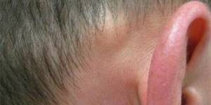 Появилась шишка за ухом: причины и лечение. Факторы риска.