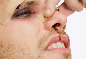 Признаки сломанного носа, как понять, что нос сломан