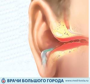 Рак среднего уха - симптомы болезни, профилактика и лечение