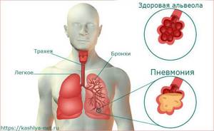 Какой кашель при пневмонии, если воспаление легких без температуры у взрослого и детей, ребенка
