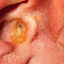 Наружный отит симптомы и лечение отита наружного уха у взрослых