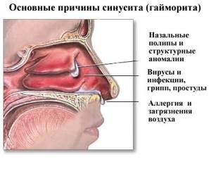 Лечение  хронического верхнечелюстного синусита: методы лечения