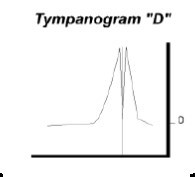Импедансометрия уха тимпанометрия типы и расшифровка результатов