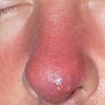 Фурункул в носу фото, как лечить чирей, осложнения