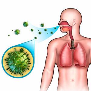 Вирусная пневмония - причины, симптомы, диагностика и лечение