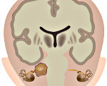 Невринома слухового нерва симптомы и лечение