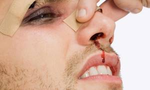 Признаки сломанного носа, как понять, что нос сломан