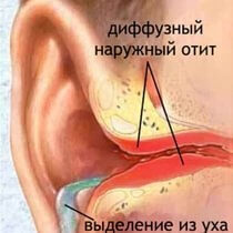 Наружный отит симптомы и лечение отита наружного уха у взрослых